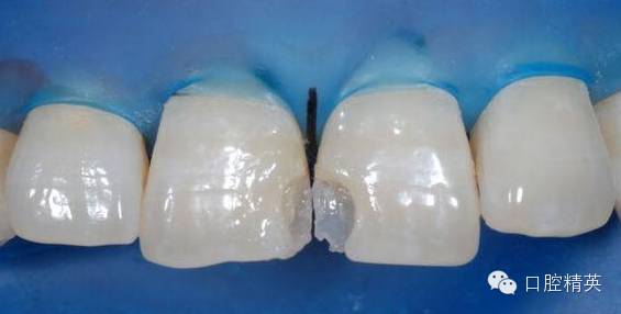 前牙树脂分层堆塑技术及其应用